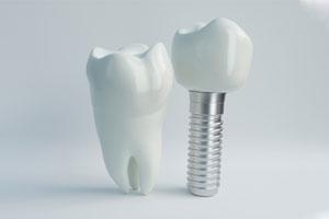 Model of tooth and model of implant